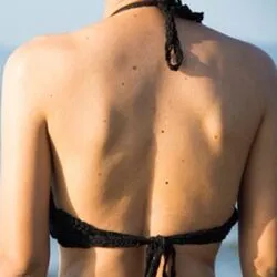Add Body Moles&Freckles